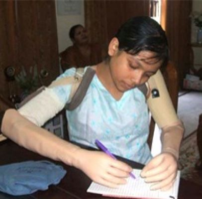 कृत्रिम हाथ लगाकर पेन-पेंसिल से लिख भी सकेंगे दिव्यांग...