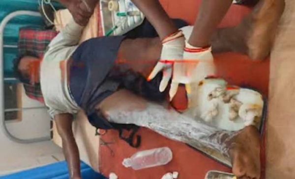 नक्सलियों द्वारा लगाए गए प्रेसर आईईडी विस्फोट में श्रमिक घायल