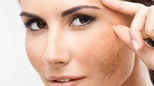 सर्दियों में पिगमेंटेशन से बचाव के घरेलू उपाय