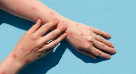 राजधानी में मिला मंकीपॉक्स का पहला मामला, मेडिकल कॉलेज में भर्ती...