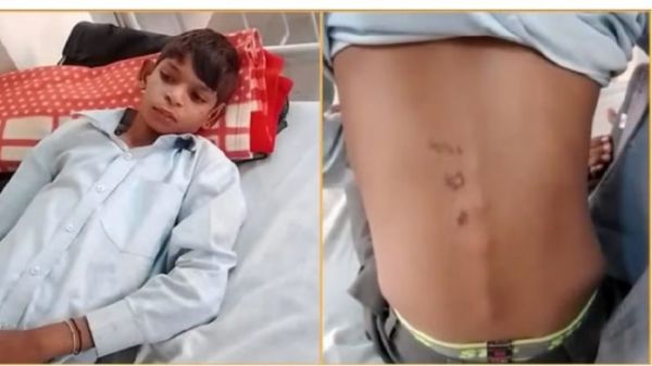 शिक्षक ने इतना मारा... कि टूट गई बच्चे की रीढ़ की हड्डी...