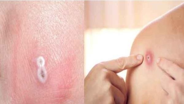 मंकीपॉक्स वर्ल्ड हेल्थ इमरजेंसी क्यों घोषित? जानिए 5 तथ्य